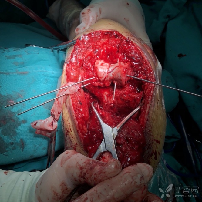 依刀手术日记———肘关节粉碎性骨折巧用2.0mm锁定螺钉