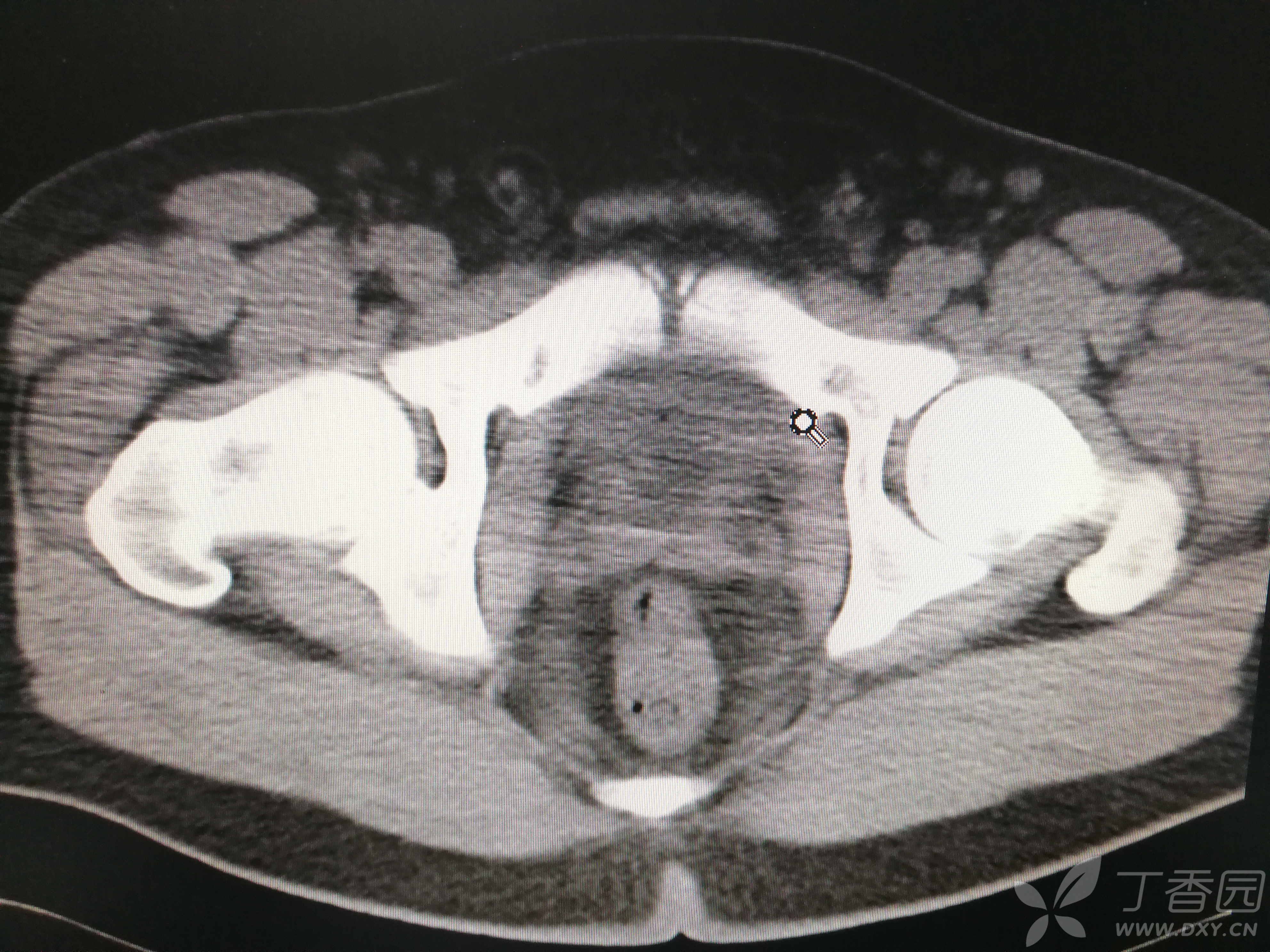 膀胱ct图片