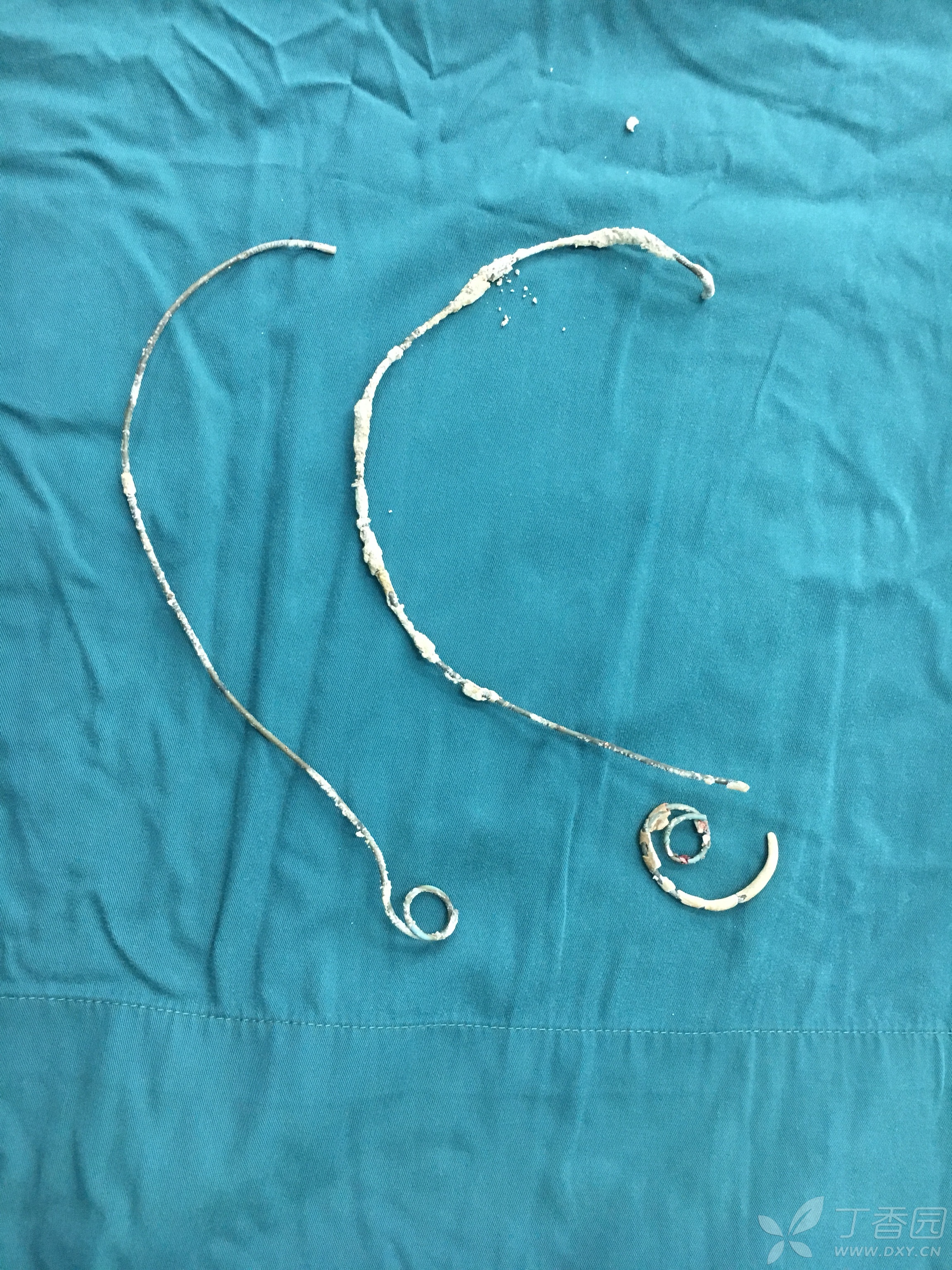 分享一例输尿管支架管滞留3年的女性患者成功拔出输尿管支架管的故事