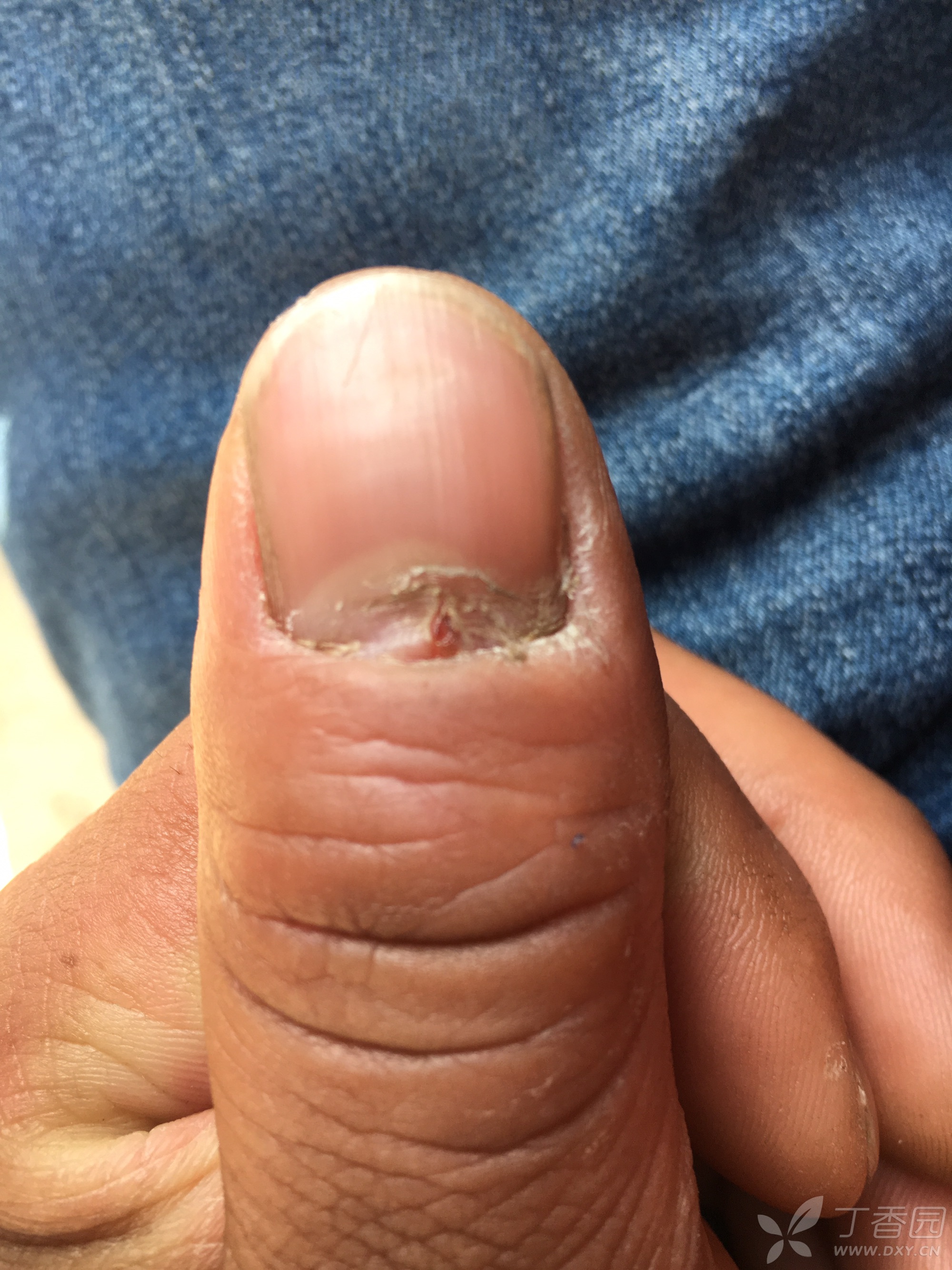 指甲缝裂开是什么原因图片