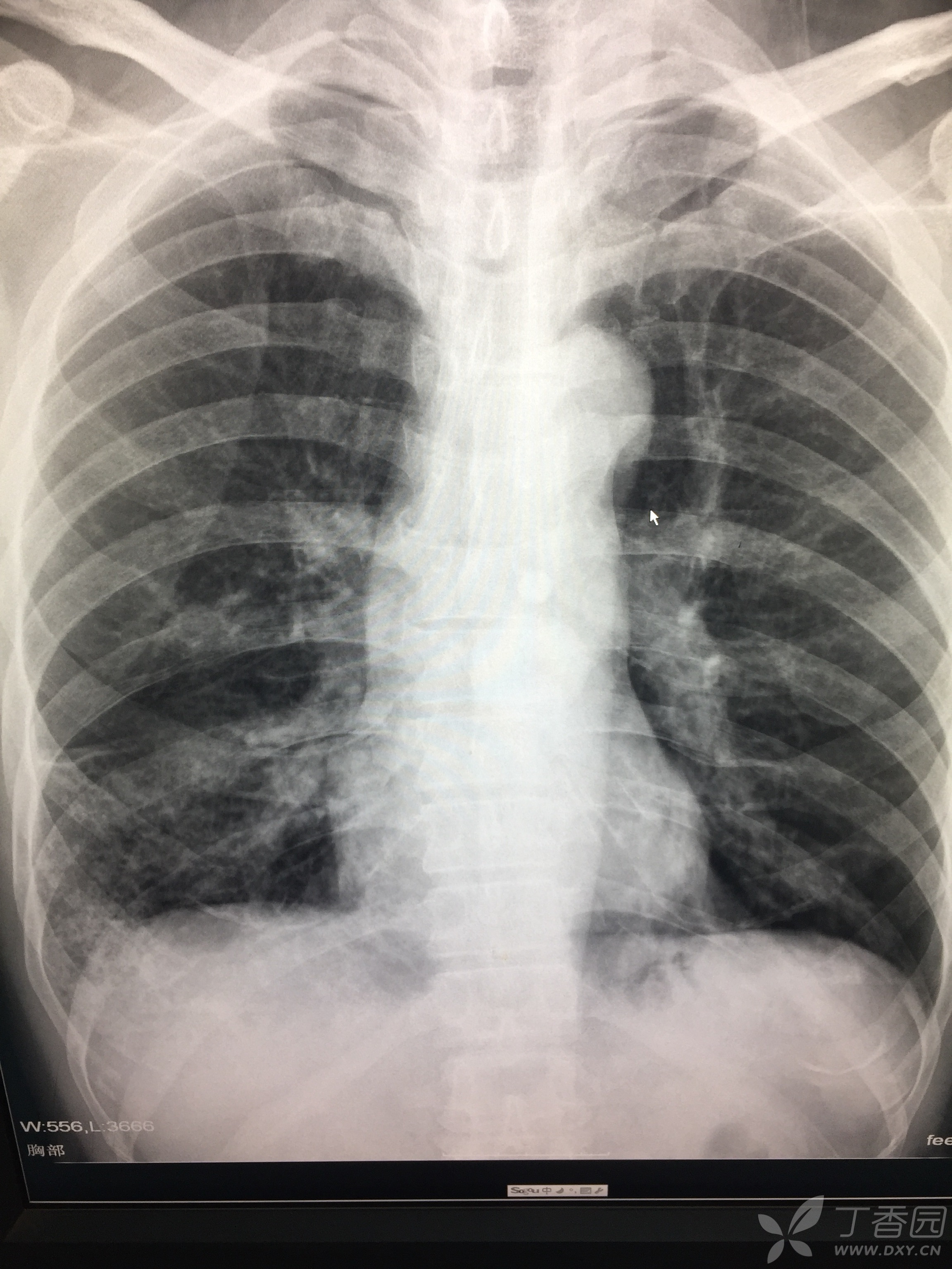 间质性肺炎x线图片图片