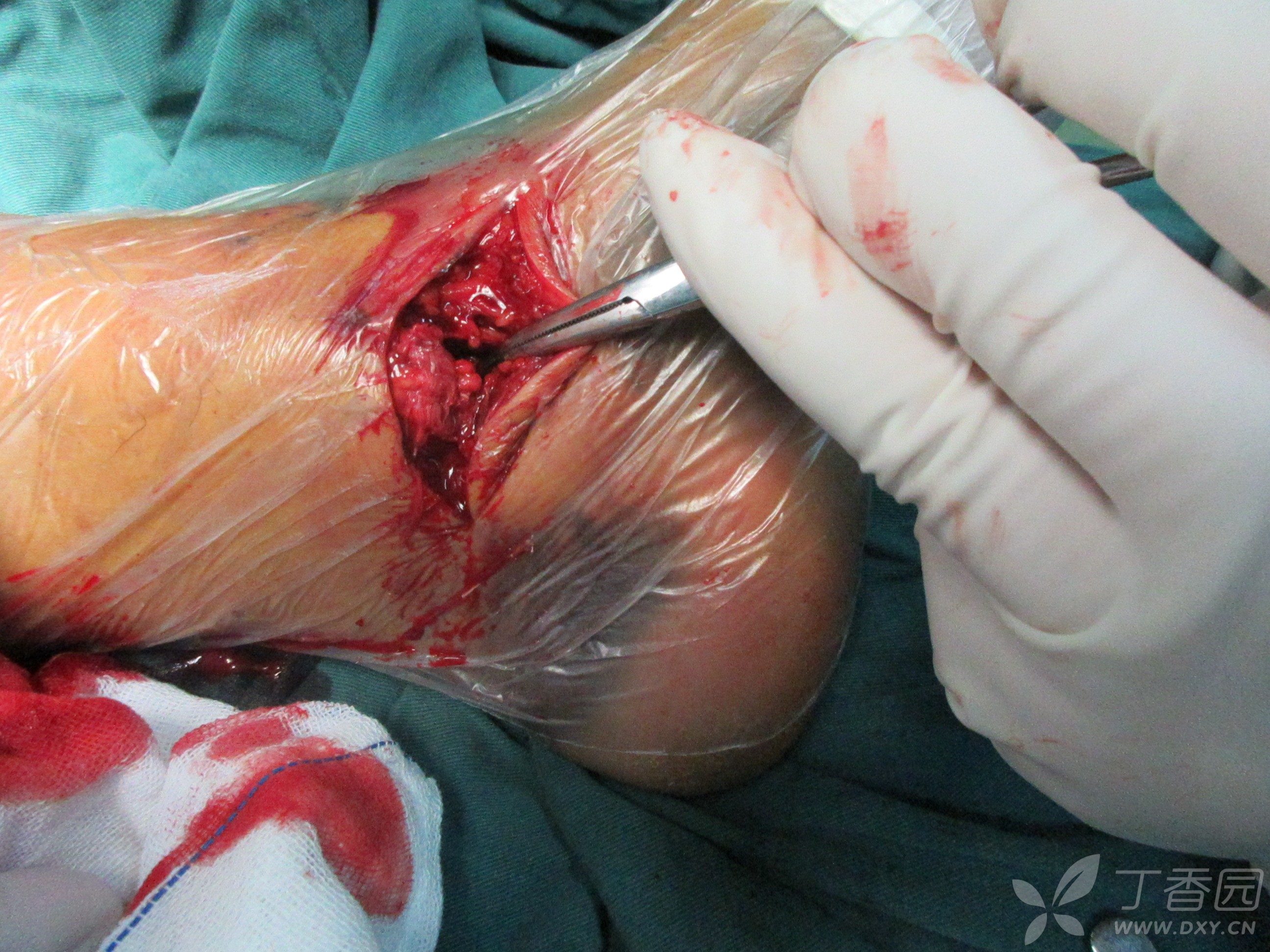 左踝关节脱位手术治疗 [病例帖]