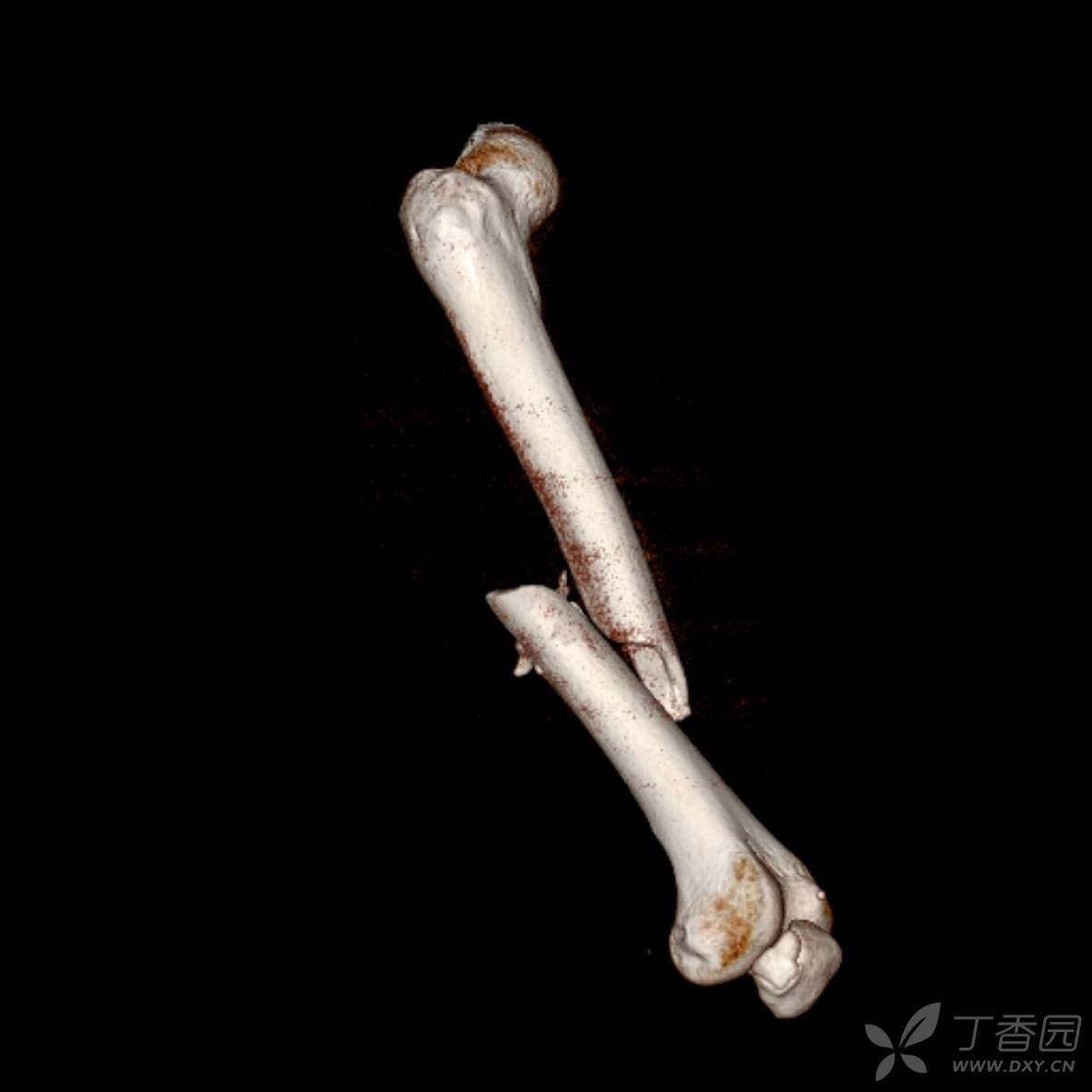 易误诊的二分髌骨 - 丁香园论坛