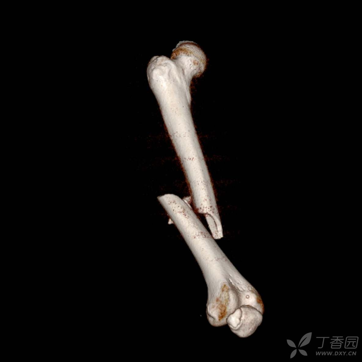 易误诊的二分髌骨 - 丁香园论坛