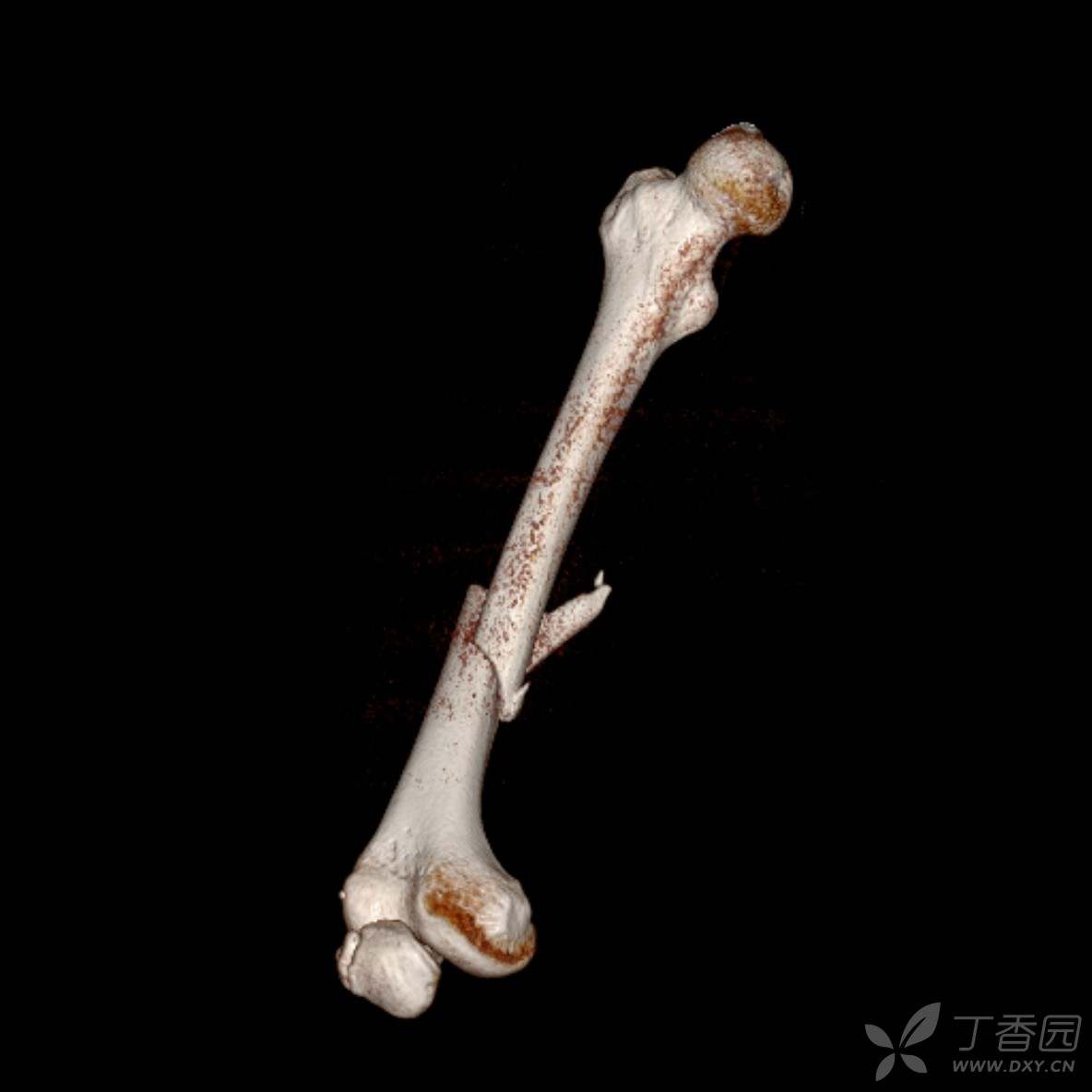 易误诊的二分髌骨 - 丁香园论坛