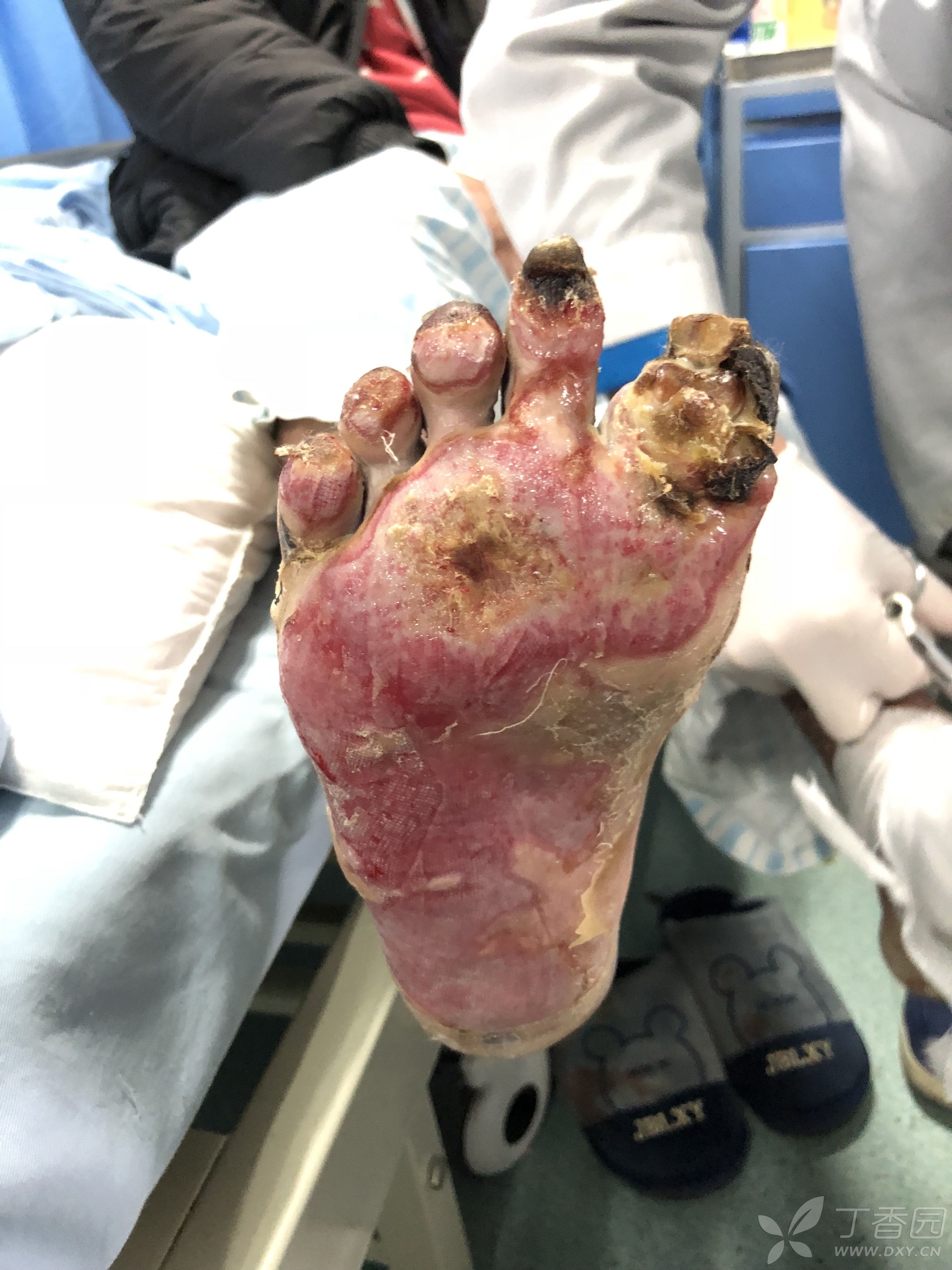 双足感染,血糖正常 [病例帖]