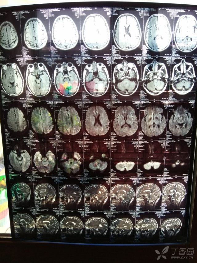 求专家看这核磁报告严重吗?脑梗和脑动脉硬化