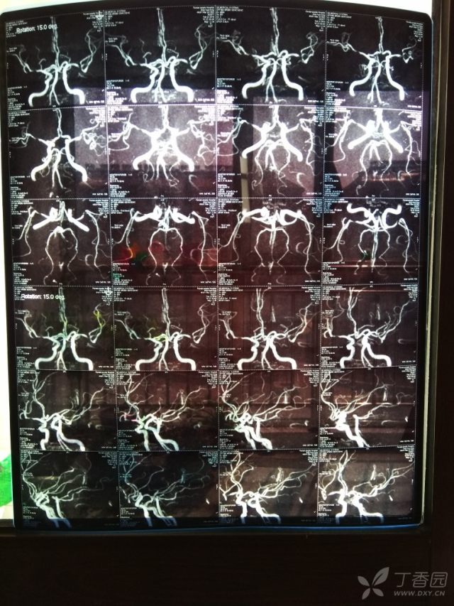 求专家看这核磁报告严重吗?脑梗和脑动脉硬化