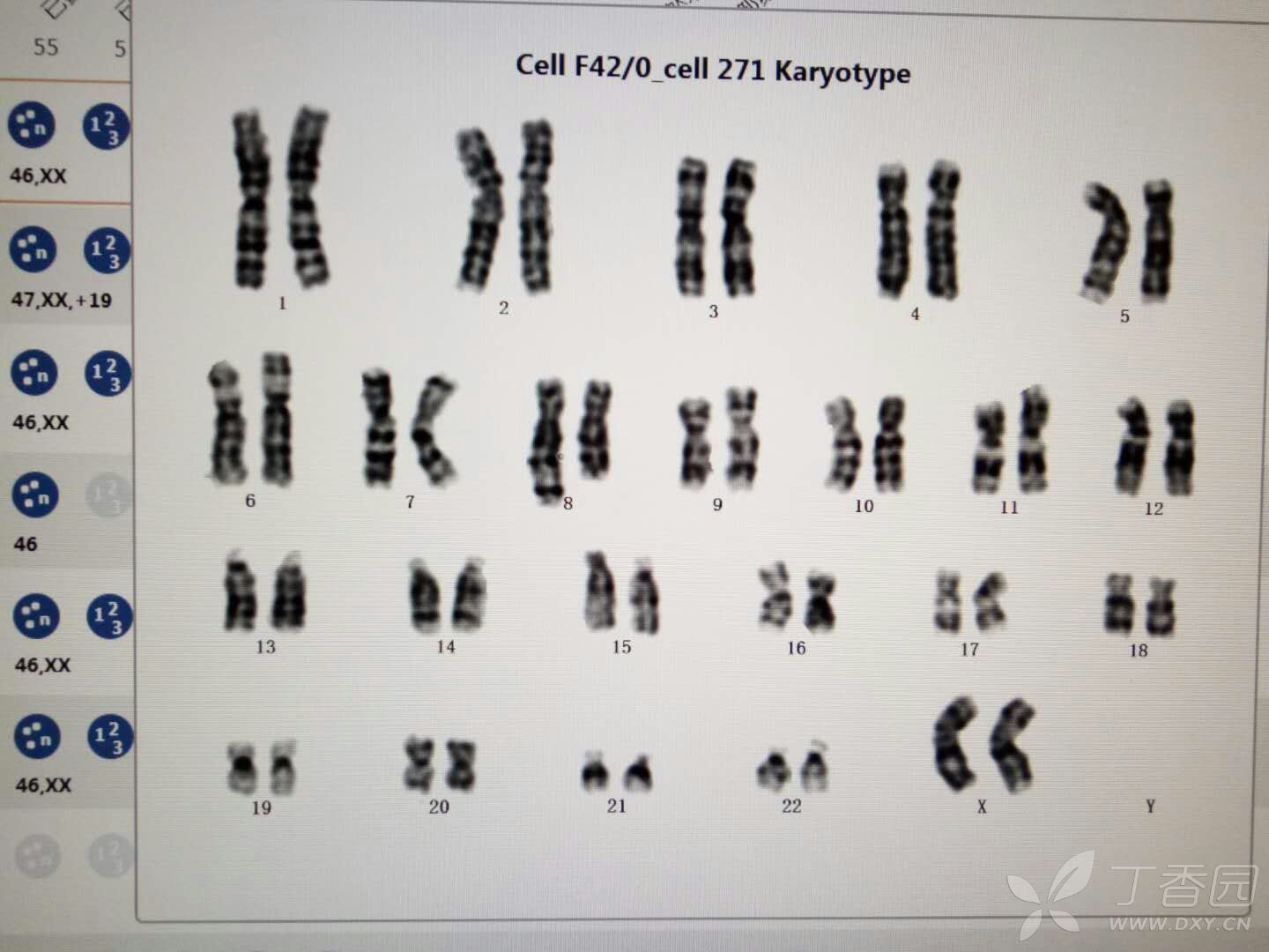 孩子有一些唐氏綜合症的特徵,但報告單上卻沒有體現21號染色體多一條