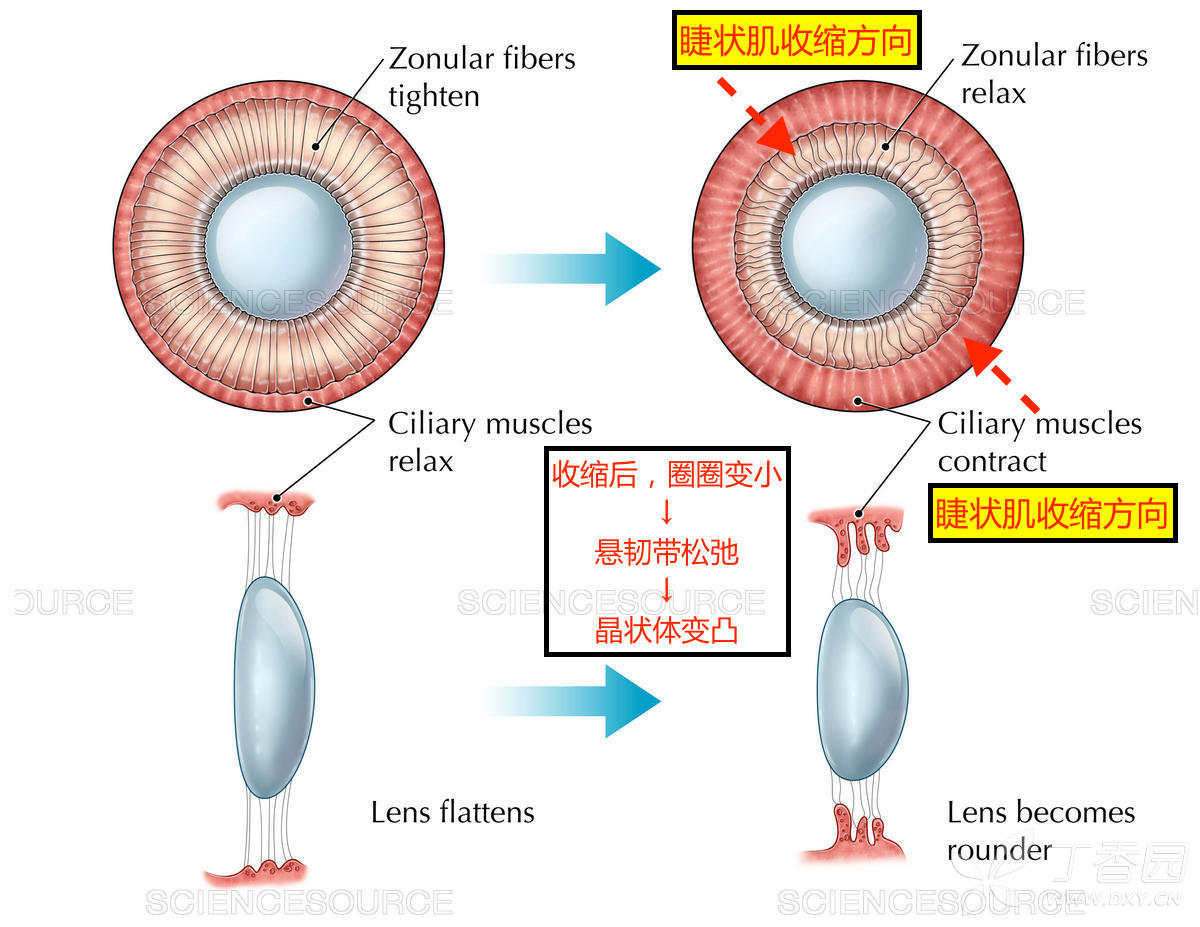 通俗易懂解释睫状肌收缩时,悬韧带松弛,晶状体变凸(图解) - 考研交流
