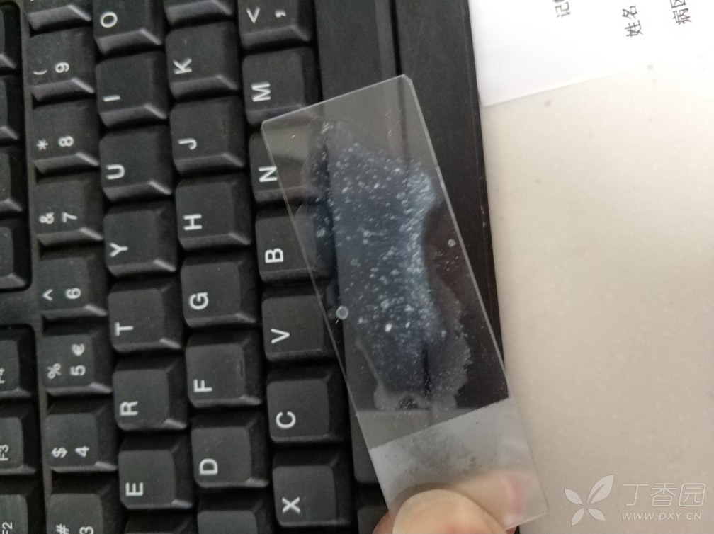 请问各位老师,这个前列腺液结果如何报