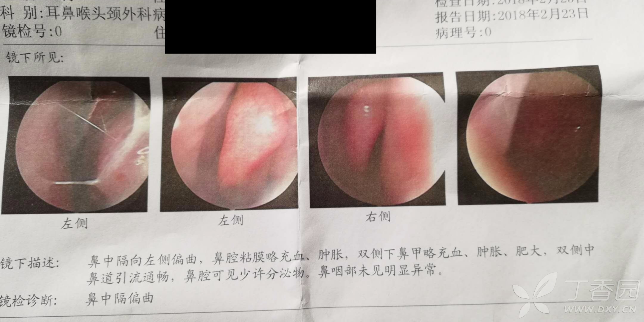 做了听力,听性脑干反应,鼻腔镜,鼻窦ct,报告都说正常