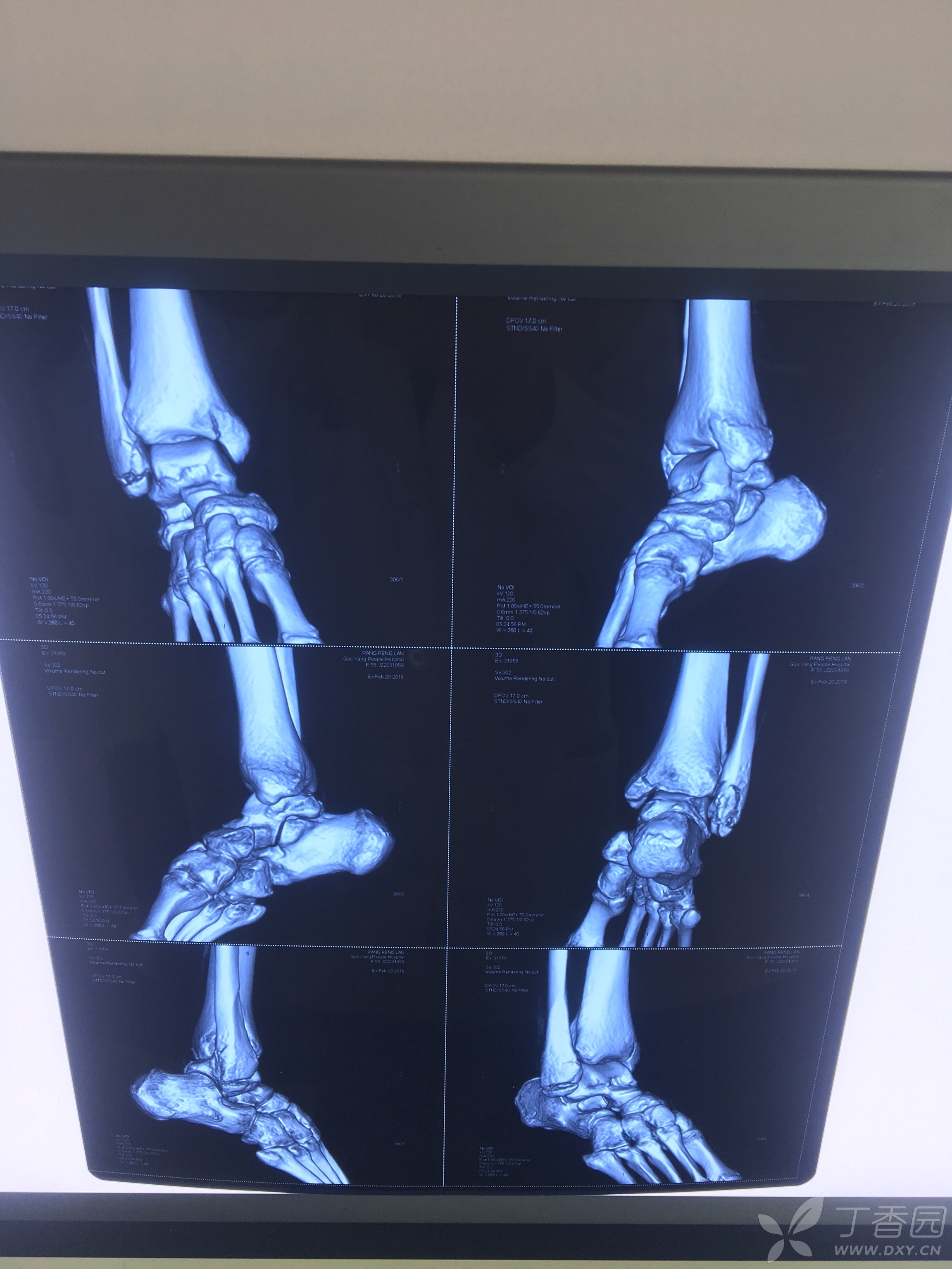 内外踝骨折,手术还是保守治疗