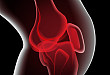 膝关节运动损伤的 3 种影像学表现，你都知道吗？