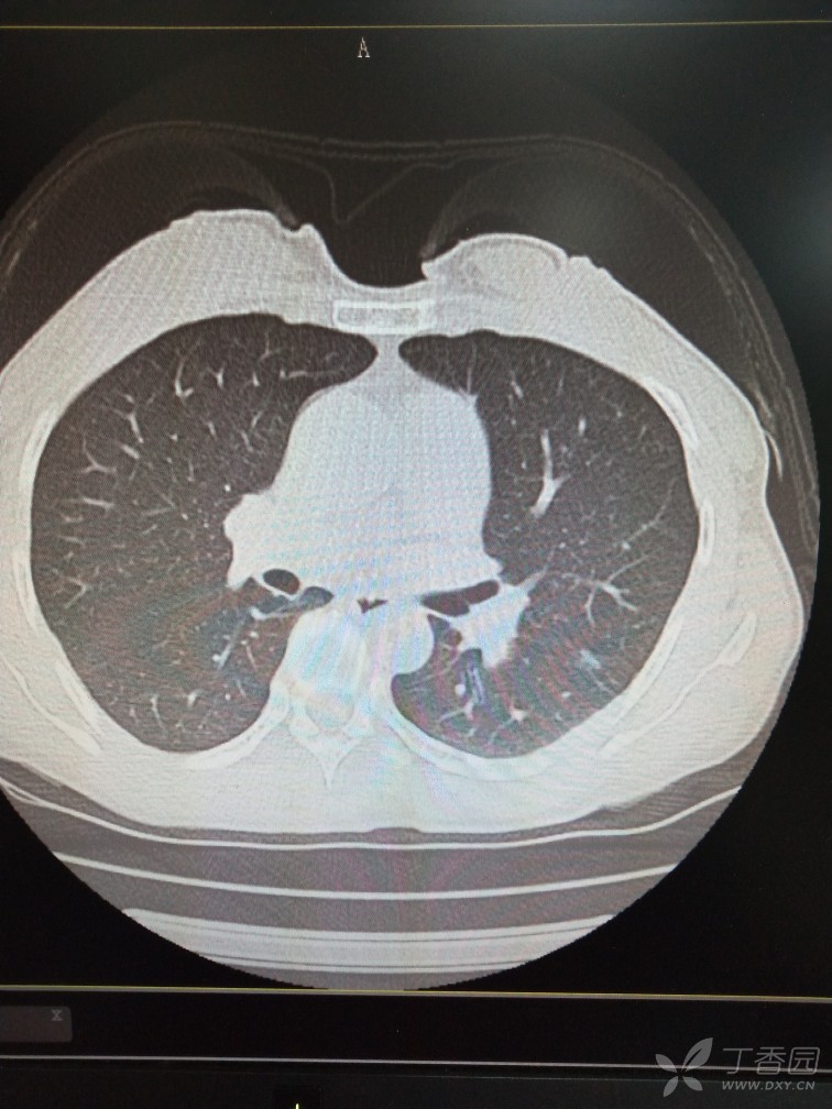 肺结节的片子图像图片