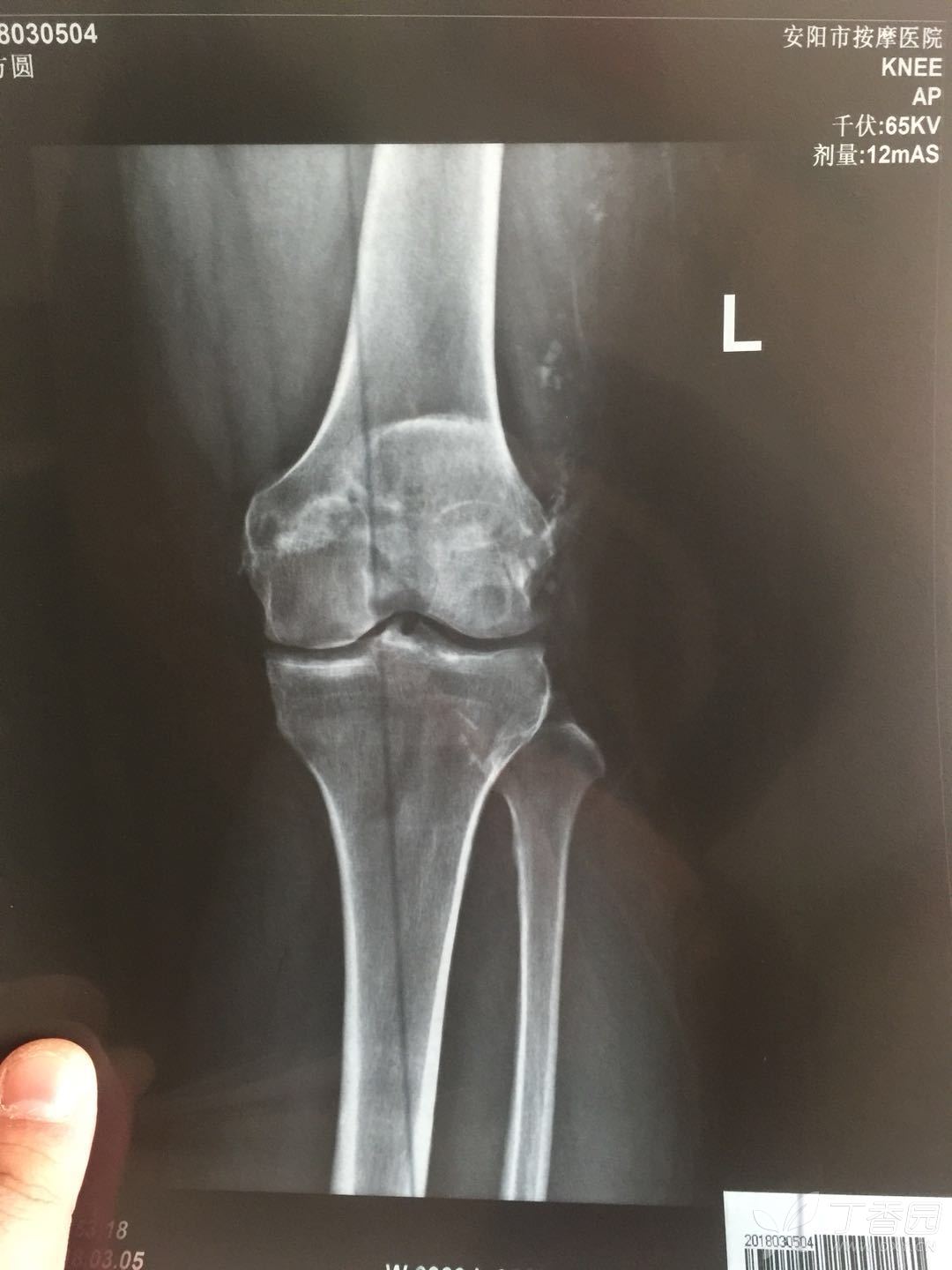 正常的膝关节影像图片图片