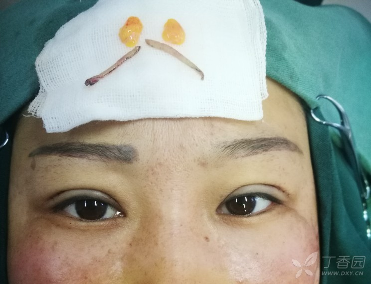 切开重睑术后 [病例帖]