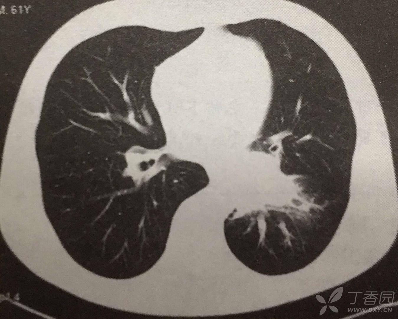 老人口唇发绀_口唇发绀图片(2)