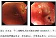 协和病例：上消化道梗阻、黄疸、胰腺病变，是……