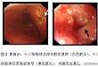 协和病例：上消化道梗阻、黄疸、胰腺病变，是……