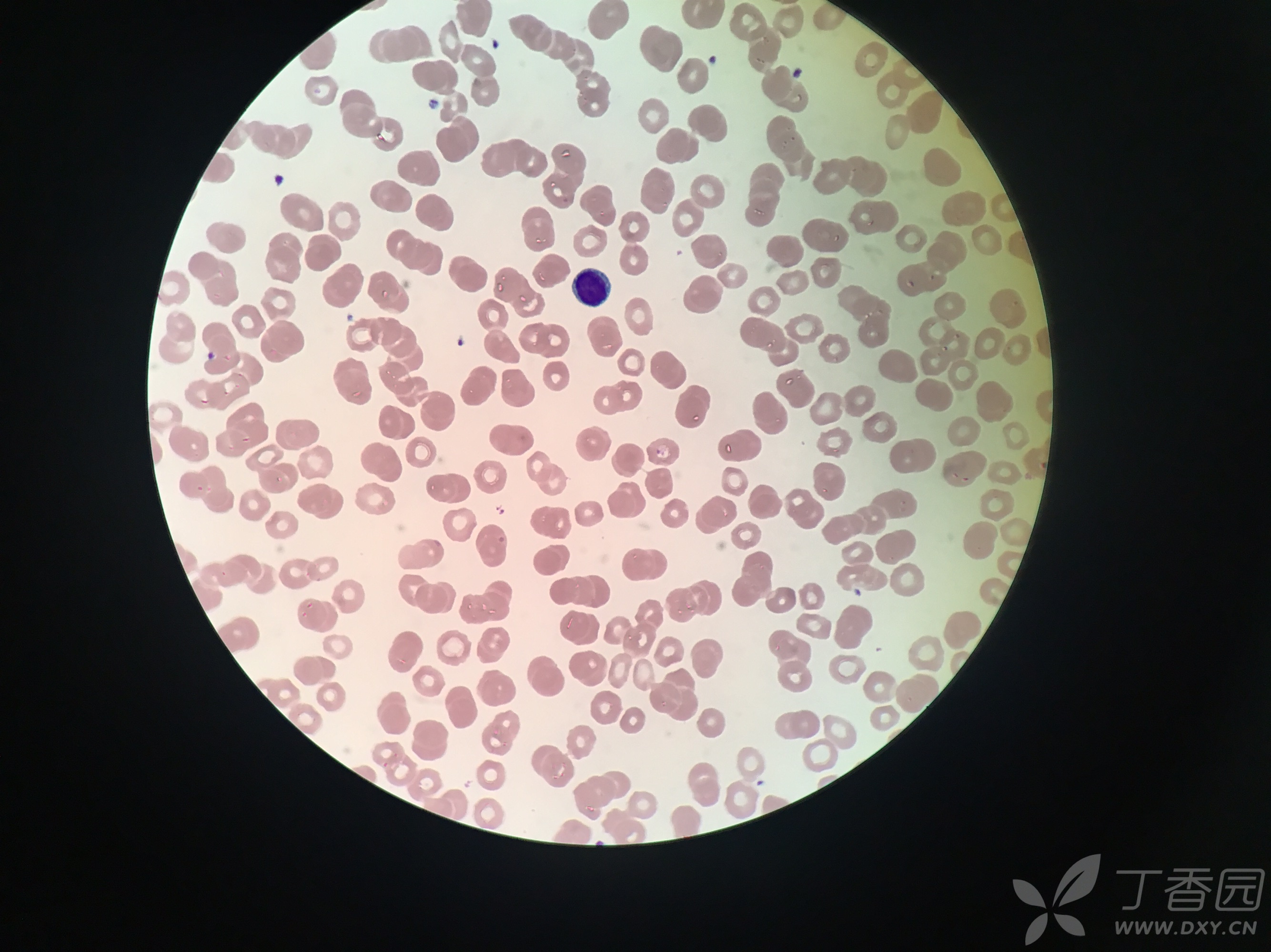 淋巴细胞单核细胞图片
