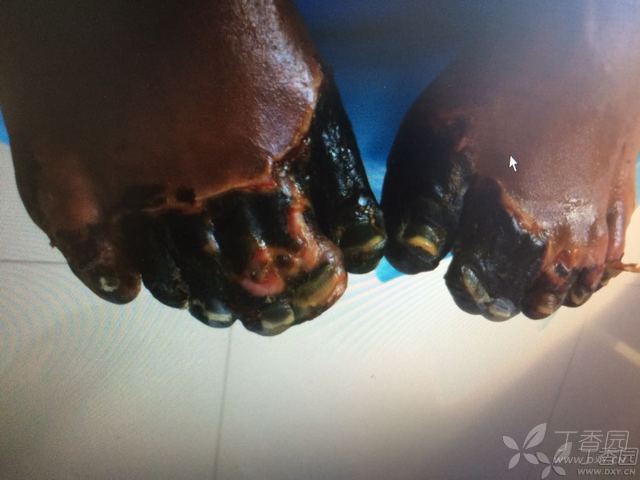 通俗易懂解释烧伤三度四分法——其实烧伤和冻伤是同一种病