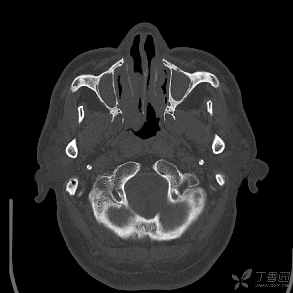 再分享一例寰椎先天变异,前弓不连左后弓缺如