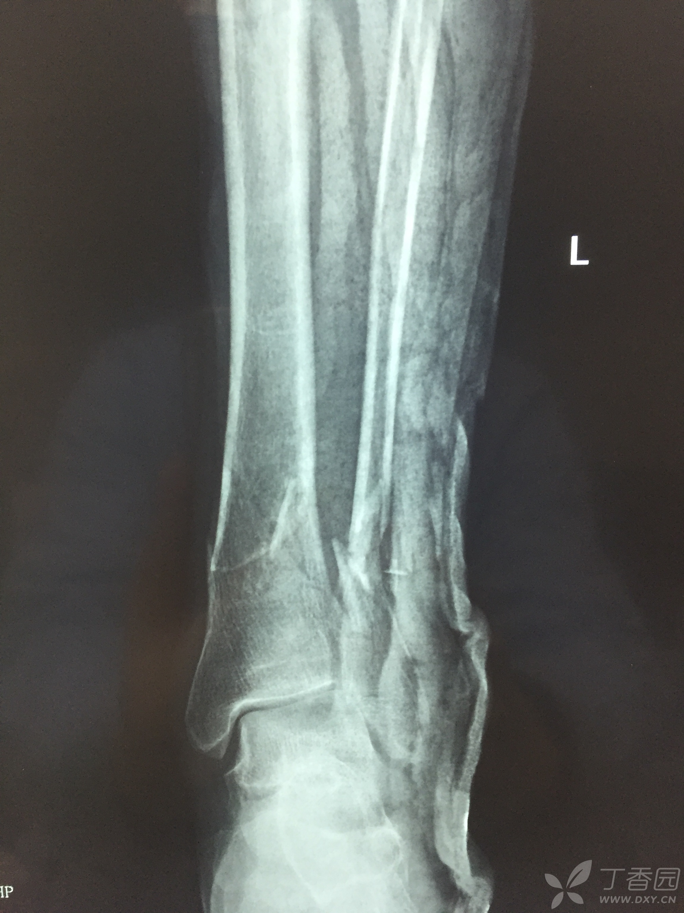 胫腓骨粉碎性骨折 骨科专业讨论版 丁香园论坛