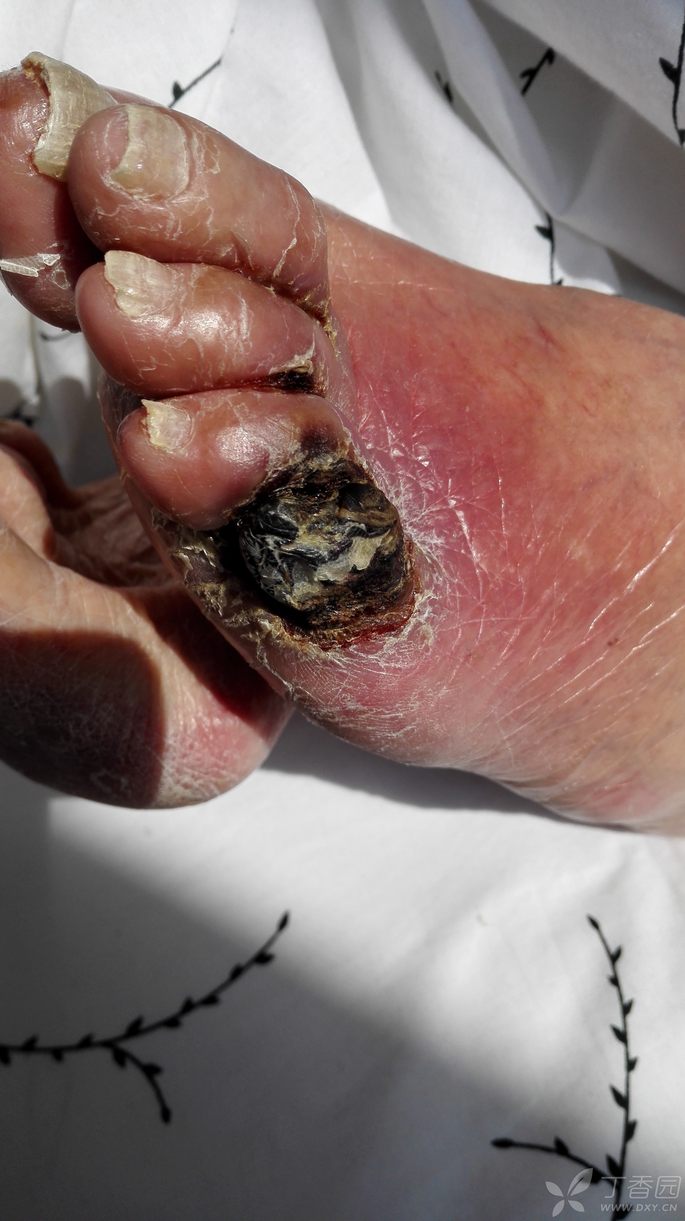 坏疽:患者女89岁,左小趾变黑破溃伴剧烈疼痛3月