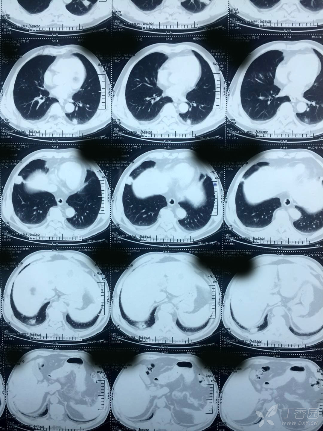 双肺多发结节 穿刺后胸腔积液 [病例帖]