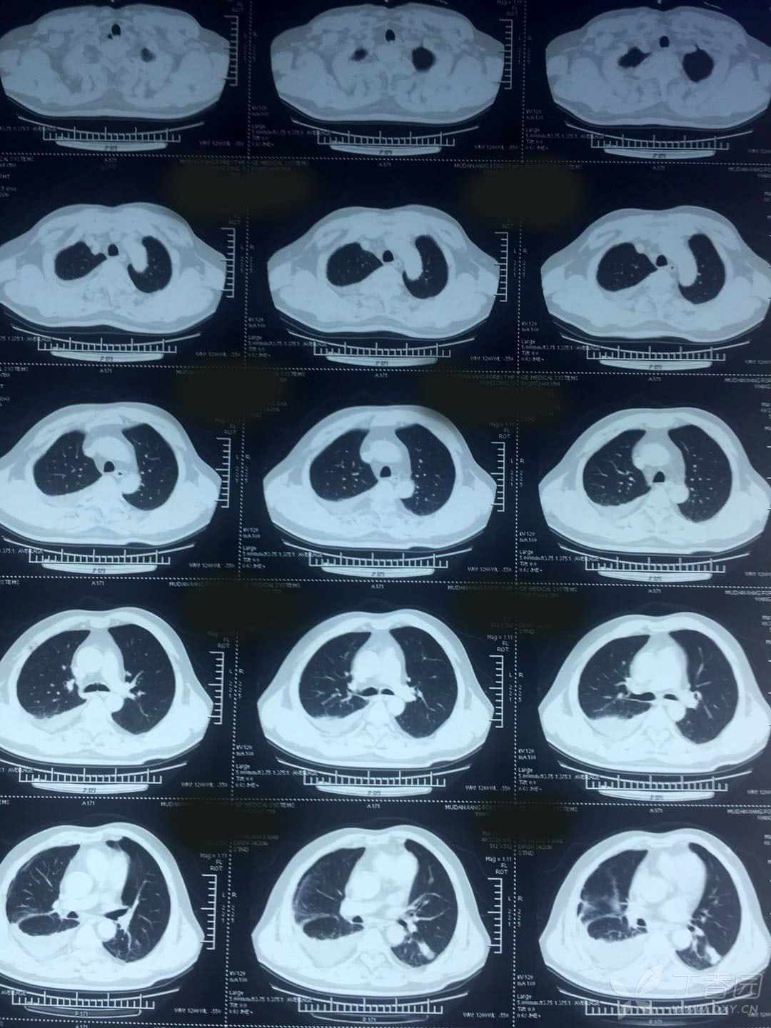 双肺多发结节 穿刺后胸腔积液 [病例帖]