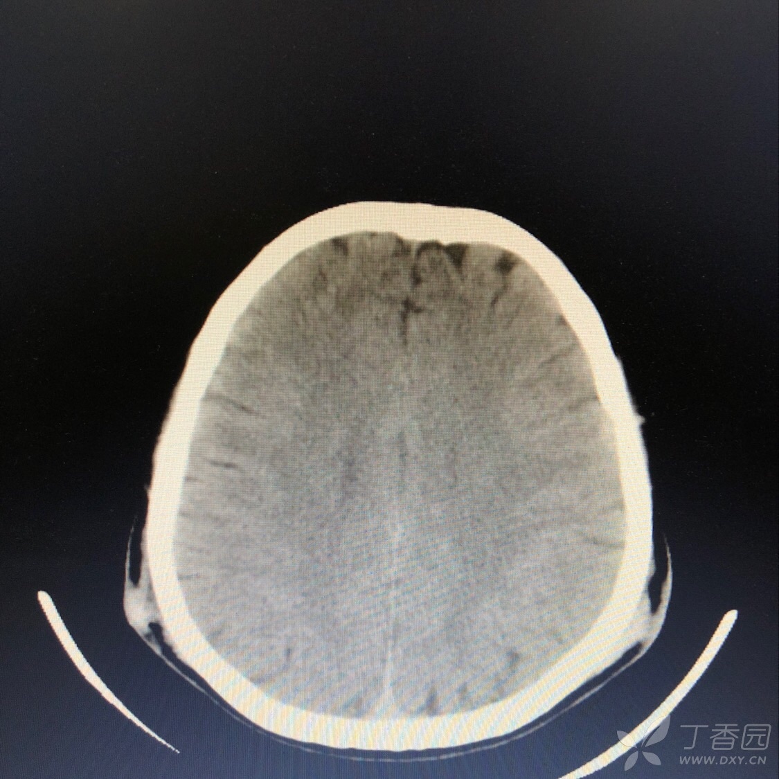 医学头皮血肿图片图片