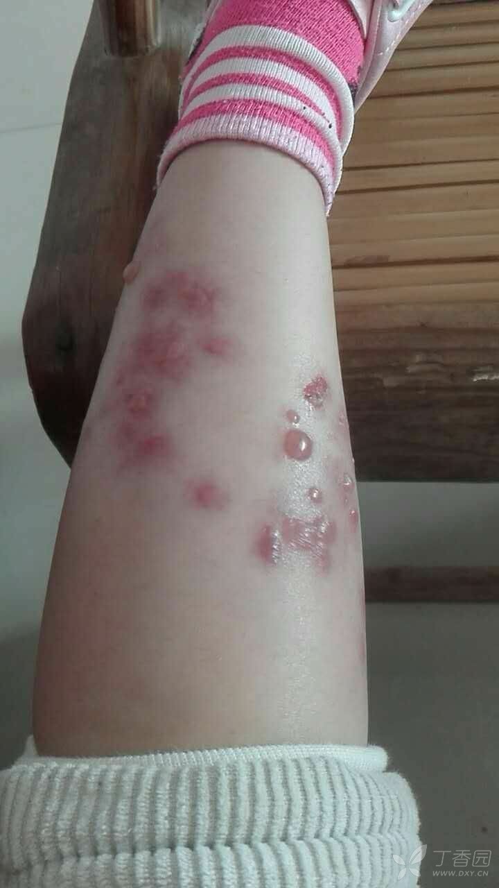 小腿带状疱疹症状图片图片