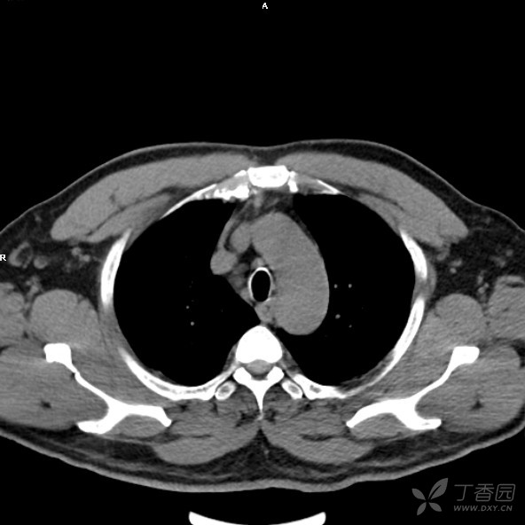 前纵隔结节,血肿?胸腺占位?