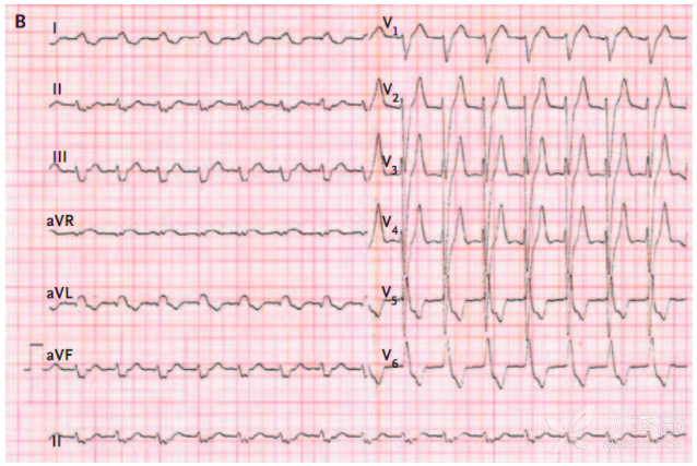 13):「搓衣板」樣的心電圖,診斷是什麼?