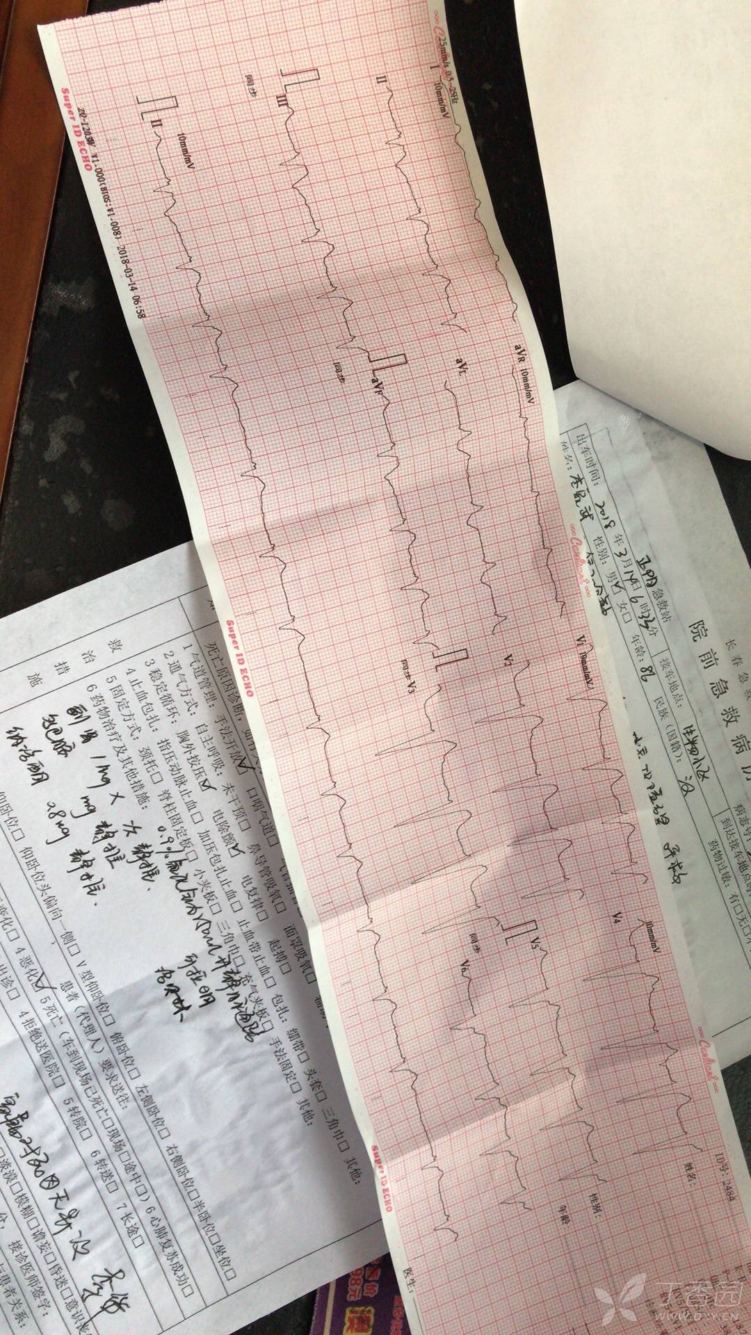 临终病人的心电图样子图片