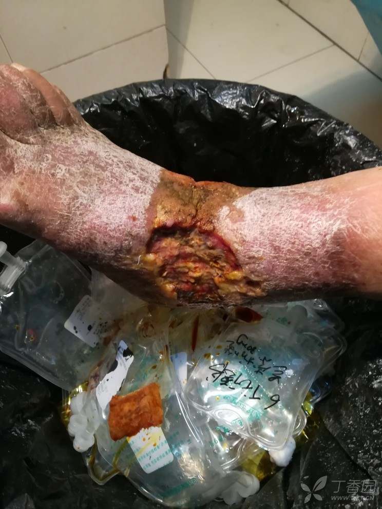 求救,静脉曲张伤口如何换药