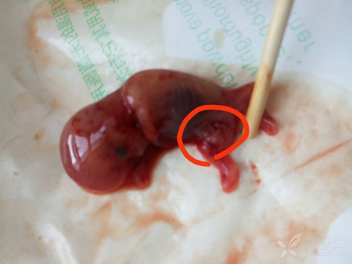 孕10周胎儿畸形 