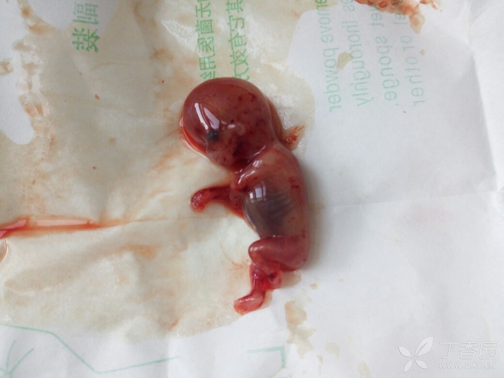 10周胎儿图片真实真人图片