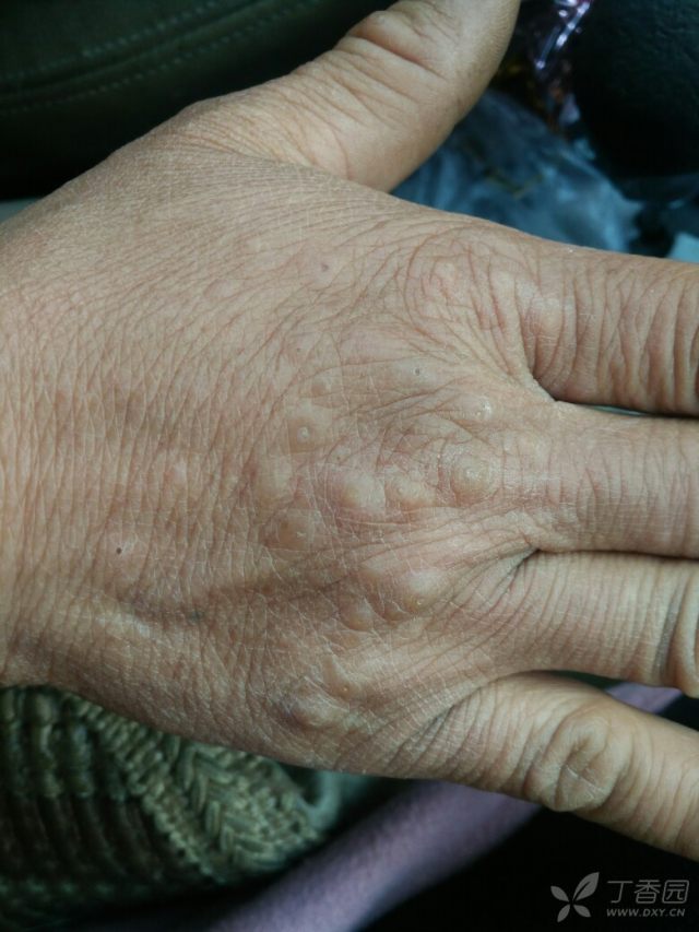 手上突然起了很多这种疙瘩