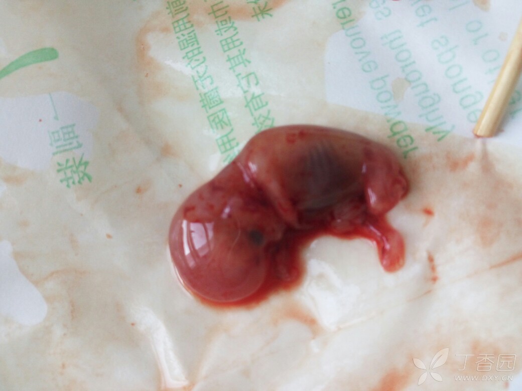 怀孕十周胎儿真实图片图片