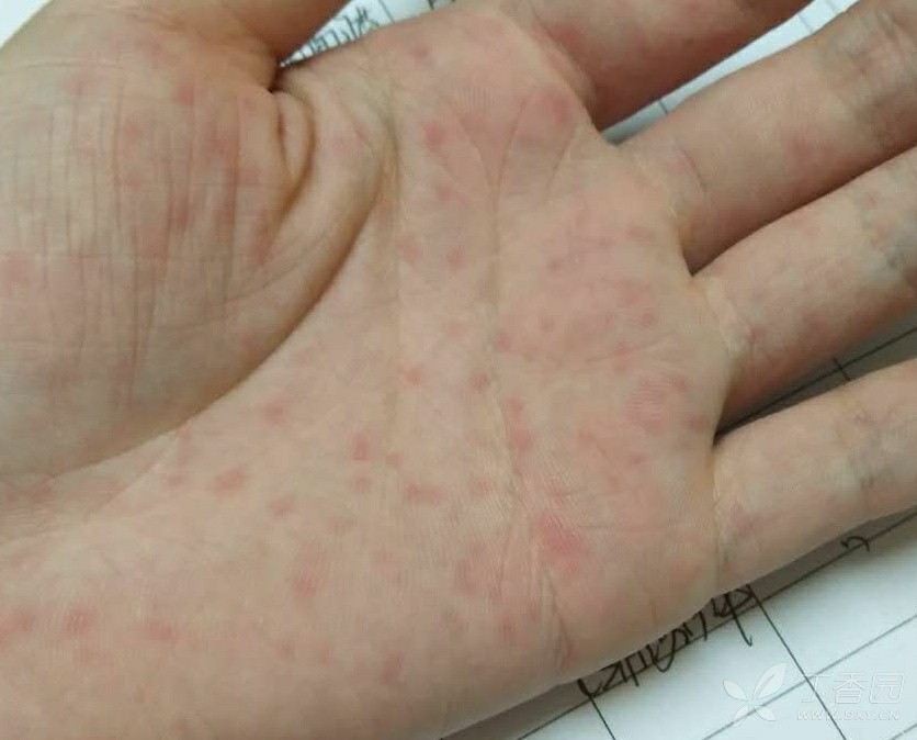 手掌湿疹症状图片