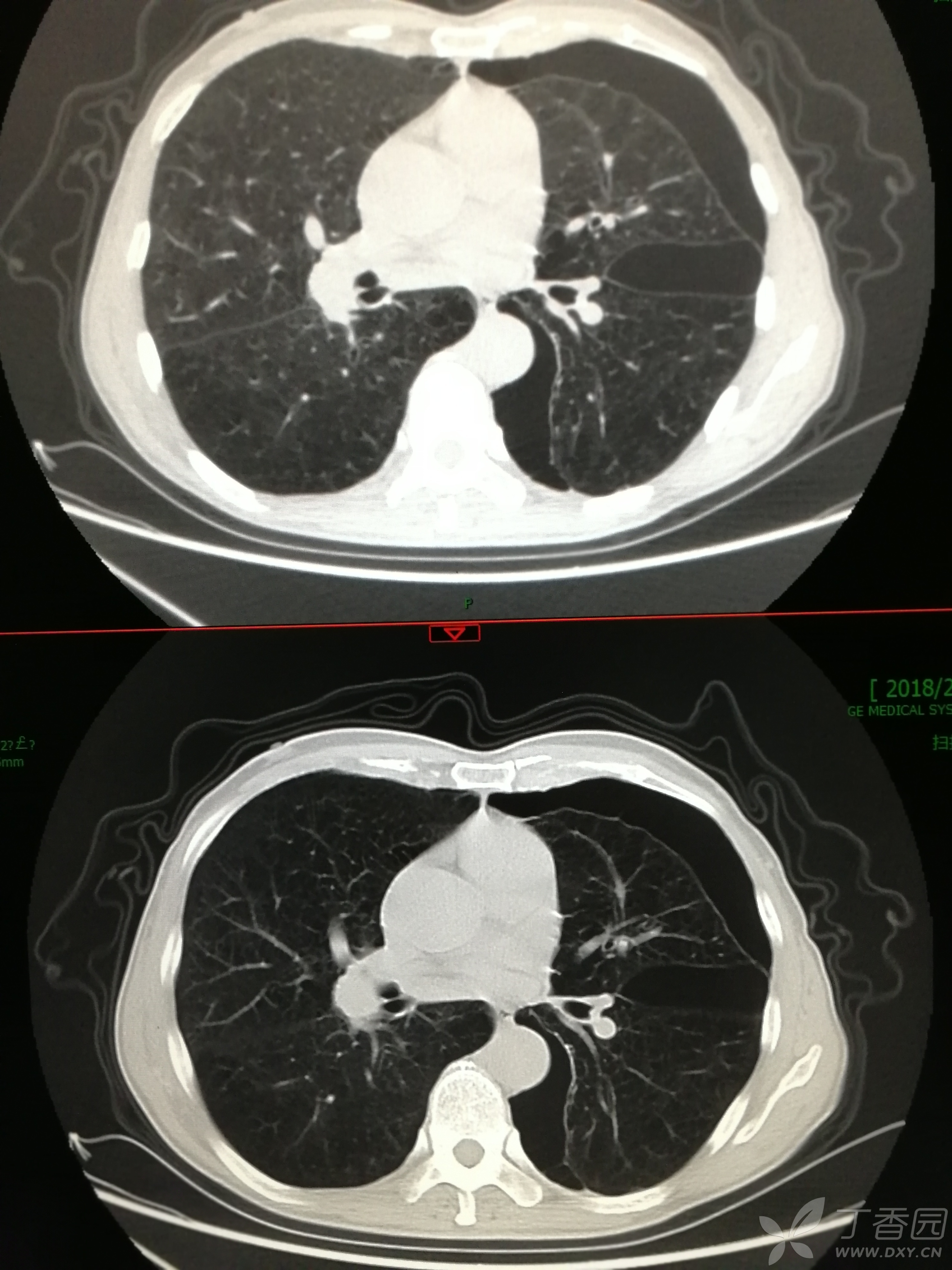 肺大泡ct图解,肺大泡在t上的图像,肺大泡t图片解读_大山谷图库