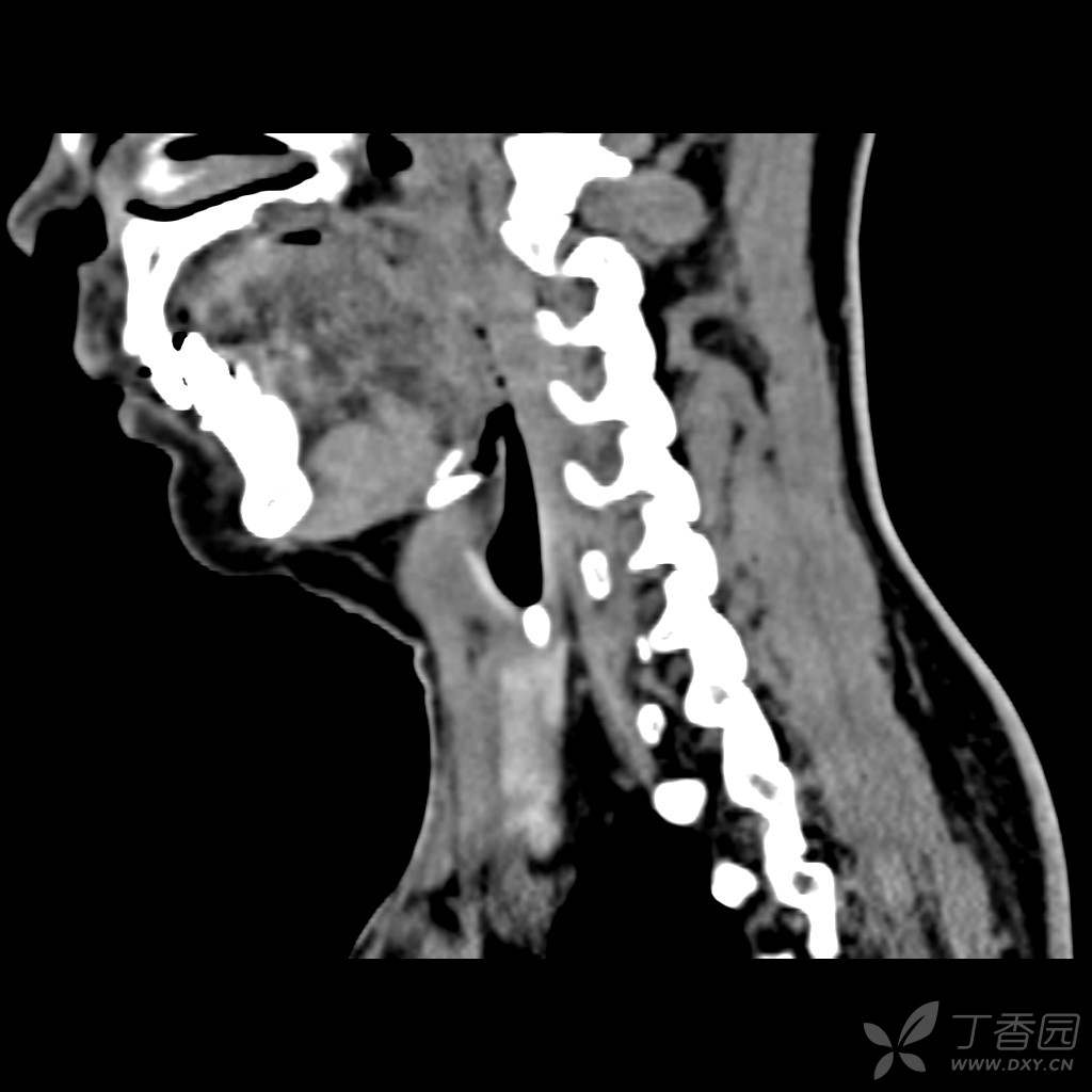 典型甲状舌管囊肿