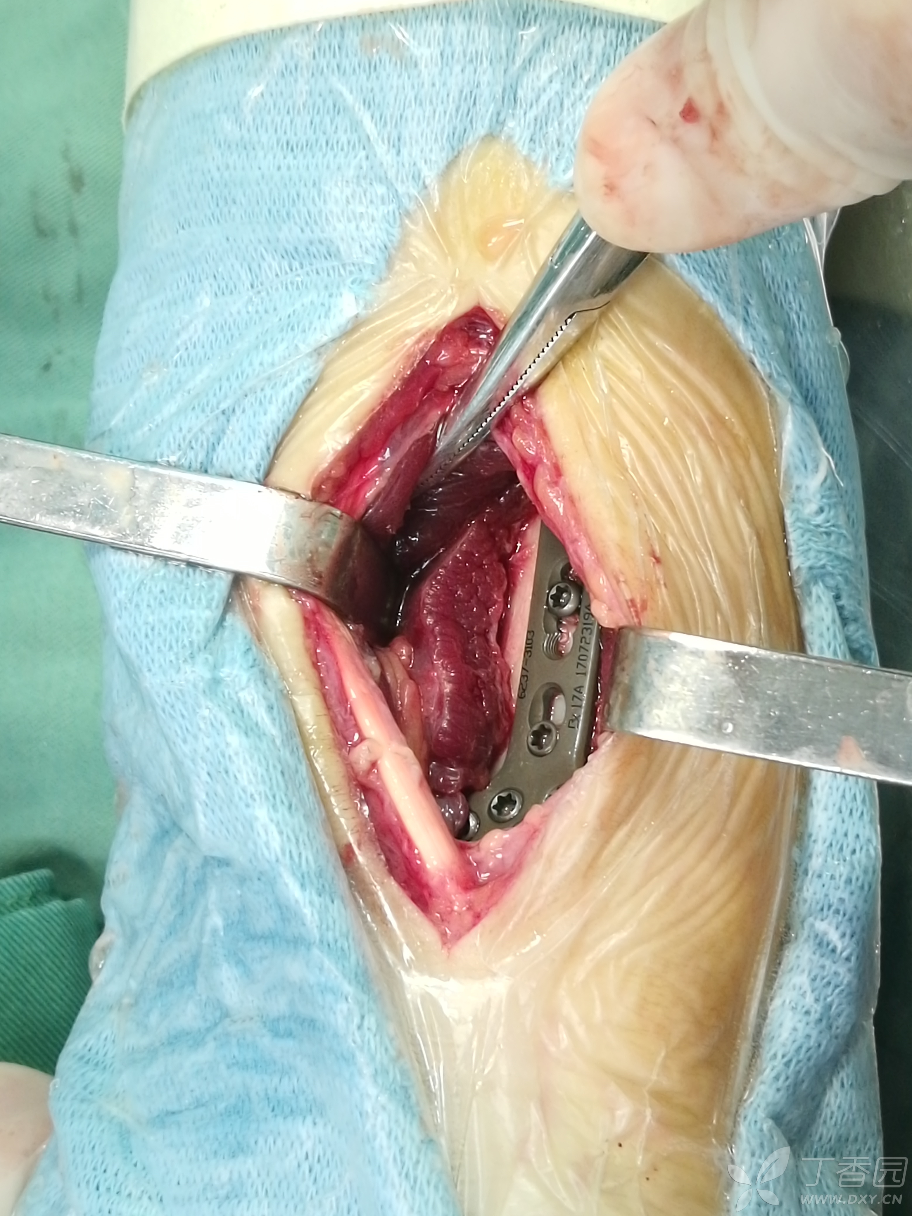 llyou 2018-03-21 18:01 腕pilon骨折(陈旧)