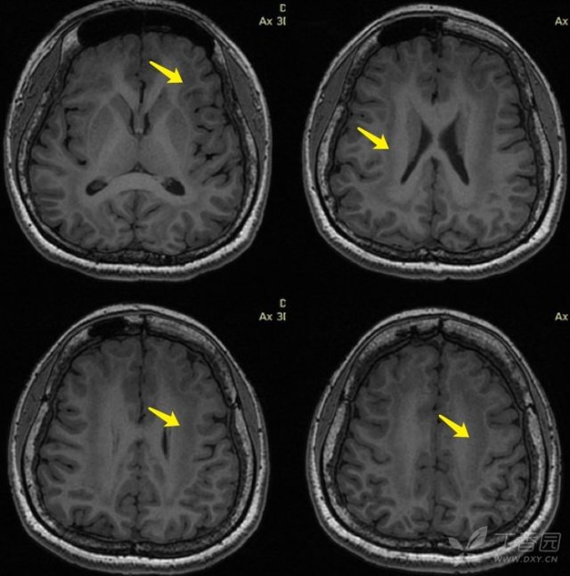脑电图存在局灶性放电,头颅磁共振提示「左侧半卵圆区缺血灶」,难道真