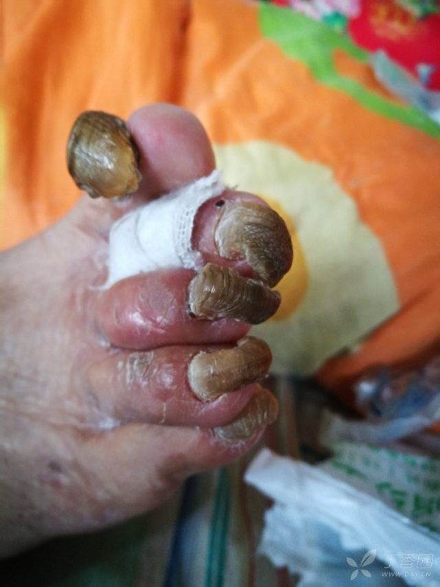 82岁老人,脚趾甲变硬变黑变厚多年,不能修剪,现出现疼痛,穿鞋有困难