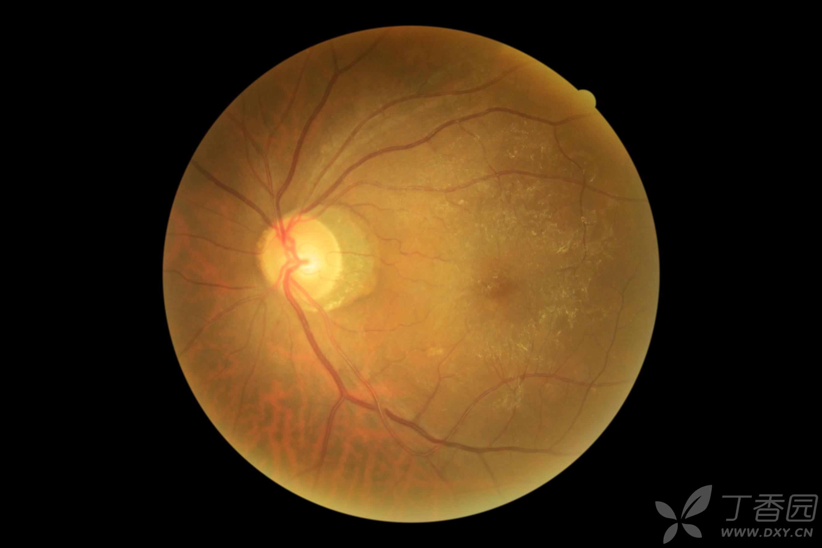 一组类似的黄斑病变. [病例帖]