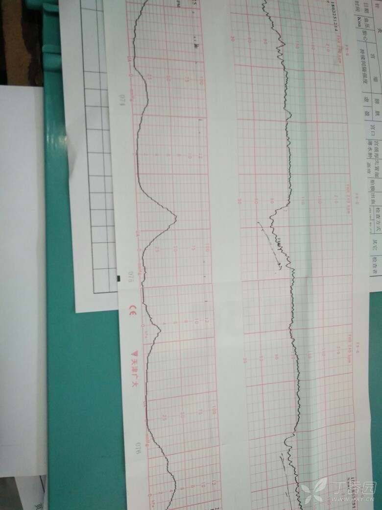 一个异常胎心监护,紧急剖宫产 - 丁香园论坛