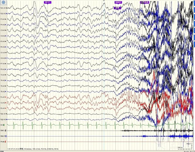 异常脑电波图片